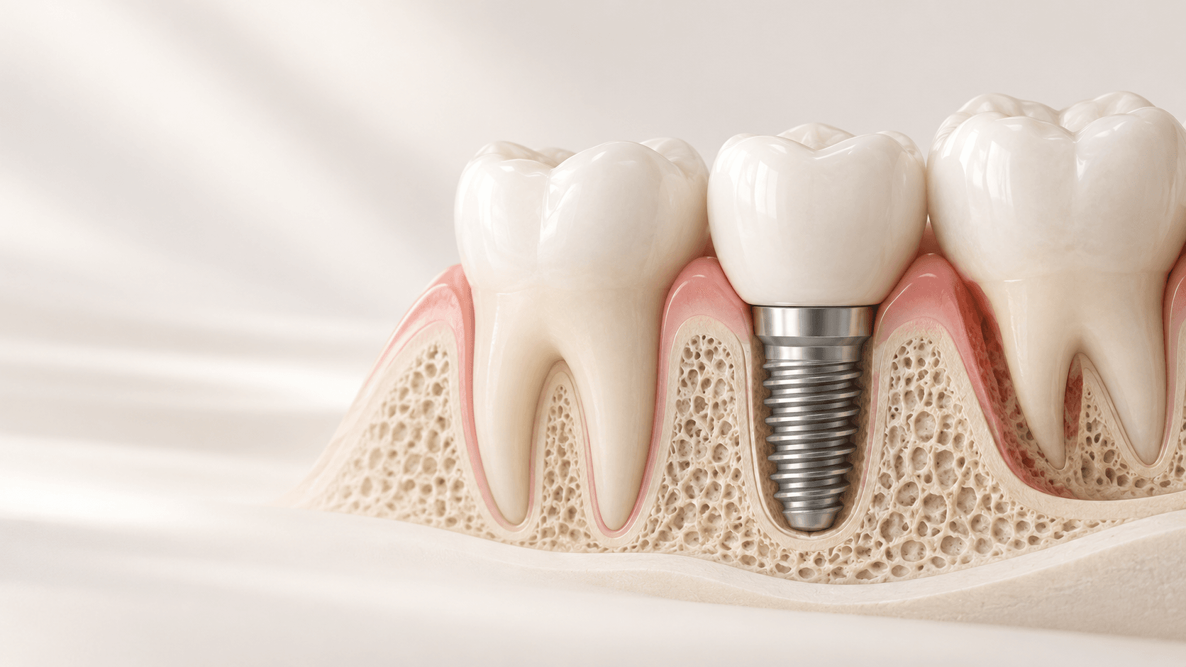 Implantatplanung nach Parodontitisbehandlung