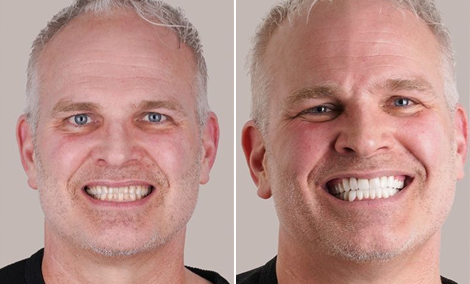 Upper-arch veneer makeover