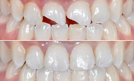 Implant-supported zirconia crowns (#35, #36)