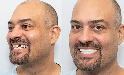 Missing tooth replaced — implant and whitening