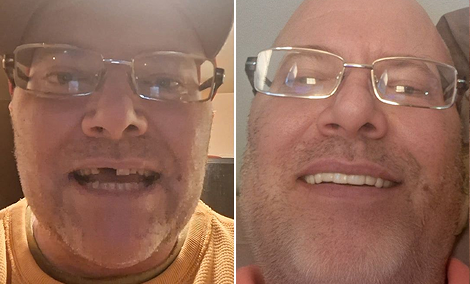 Two lost teeth restored with implants