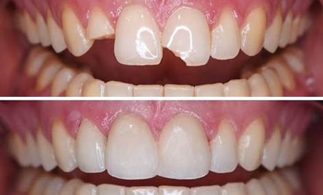 Chipped front incisors — 2 E-max crowns