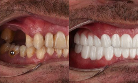 Two missing side teeth replaced — implants and whitening