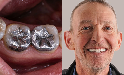 Amalgam molars replaced with zirconia crowns