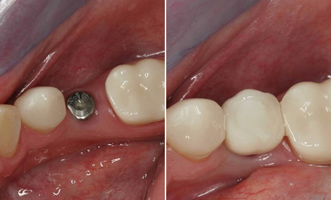 Missing tooth replaced with a single implant
