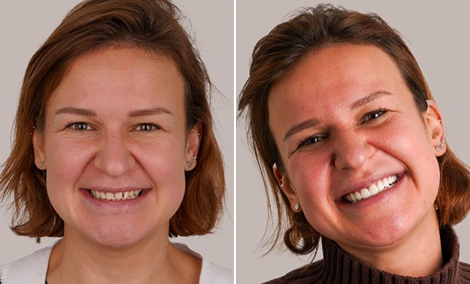 Smile makeover with Digital Smile Design