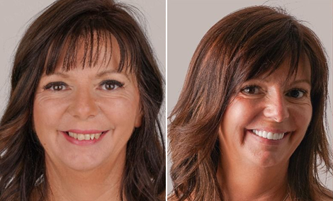 Front-teeth veneer restoration