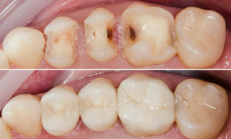 Decayed molars restored with 3 ceramic crowns