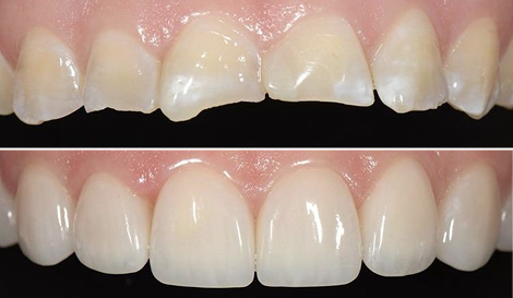 Implant-supported zirconia crowns (#35, #36)