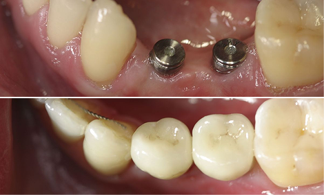Two lost teeth restored with implants