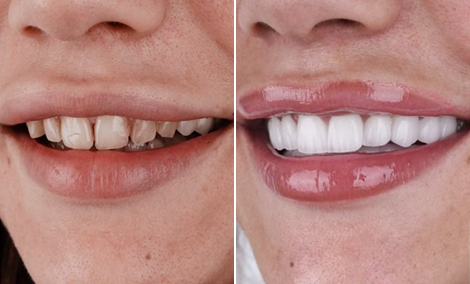 Full-mouth restoration on implants