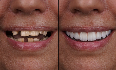 Smile makeover after whitening relapse