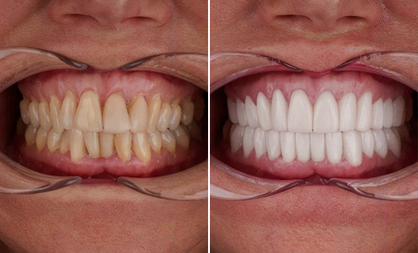 Custom smile design and whitening