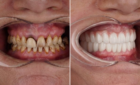 Full veneer smile design