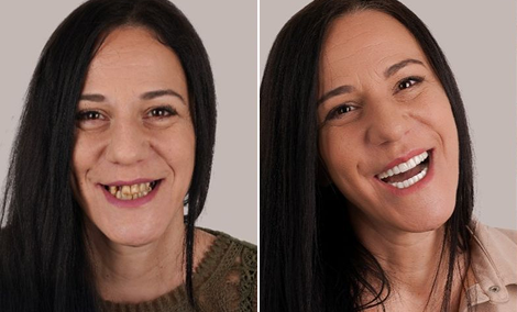 Smile makeover with gum contouring