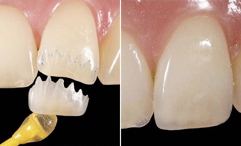 Chipped front tooth restored with a single veneer