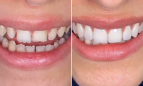 Full smile makeover — gaps closed and alignment corrected
