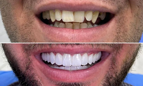 Complete smile transformation — reshaped, aligned and whitened
