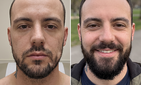 Cheeks and connectors beard restoration