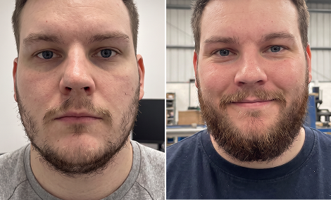 Jawline and cheek line beard restoration