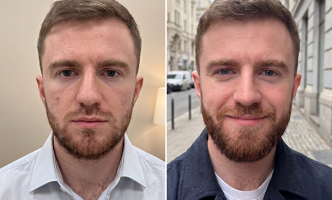 Patchy areas and density beard restoration