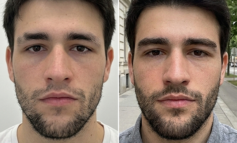 Eyebrow tail and density restoration