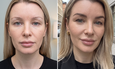 Eyebrow shape and density restoration