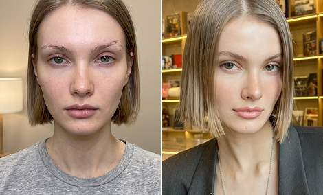 Full brow reconstruction and shaping