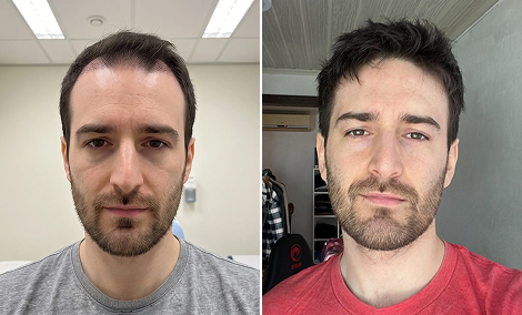Frontal M-shaped hairline restoration