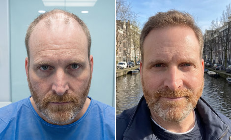 Crown and vertex hair restoration