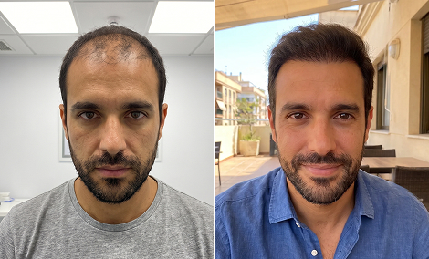 Crown and upper scalp hair restoration