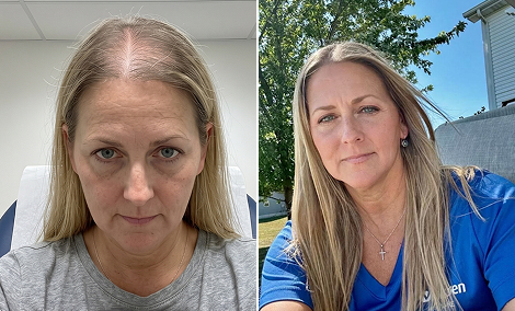 Top and part line hair restoration