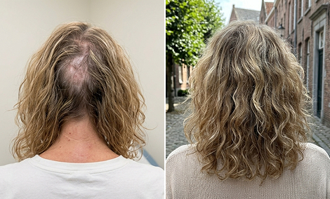 Occipital area scar and hair restoration