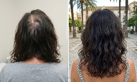Posterior scalp hair restoration