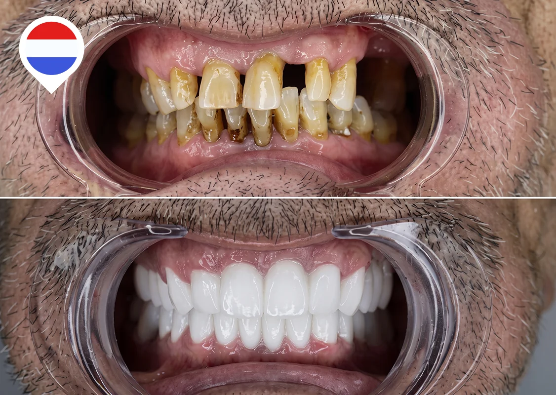 Full mouth rebuild after gum disease