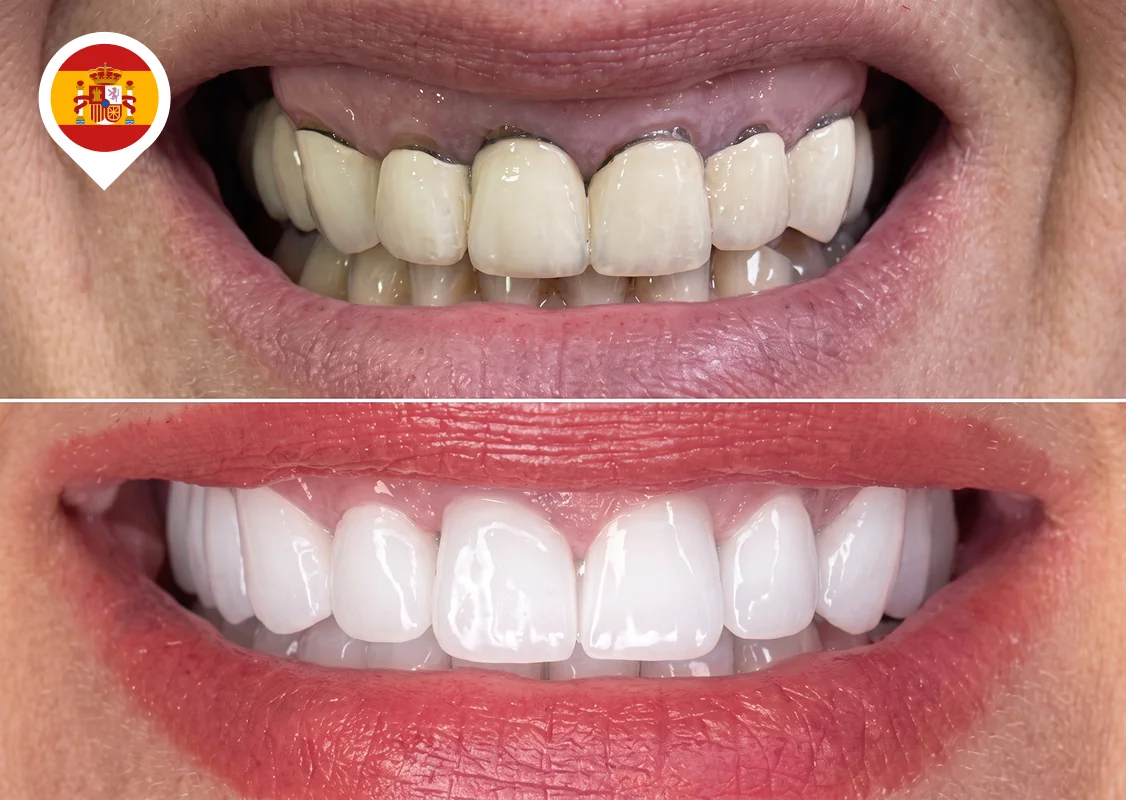 Old metal-ceramic crowns replaced