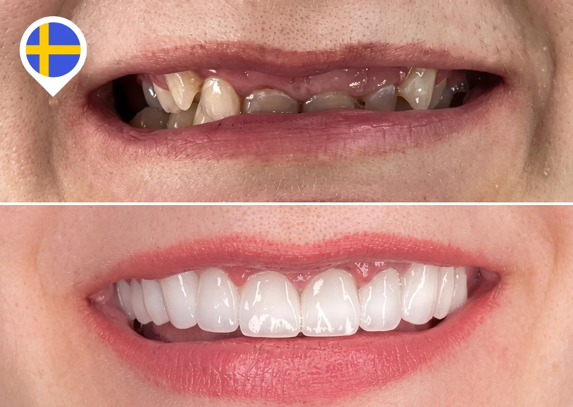 Broken upper teeth rebuilt on implants