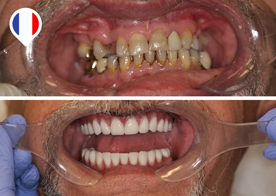 Missing upper and stained lower teeth