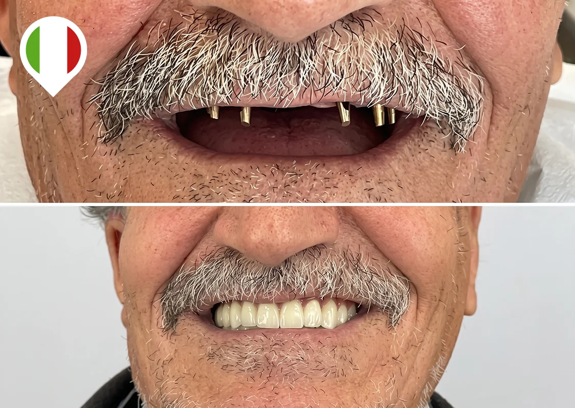 Permanent upper teeth for a toothless jaw