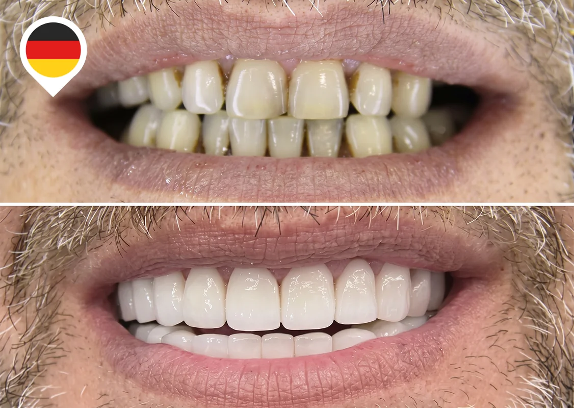 Worn, yellowed teeth fully restored