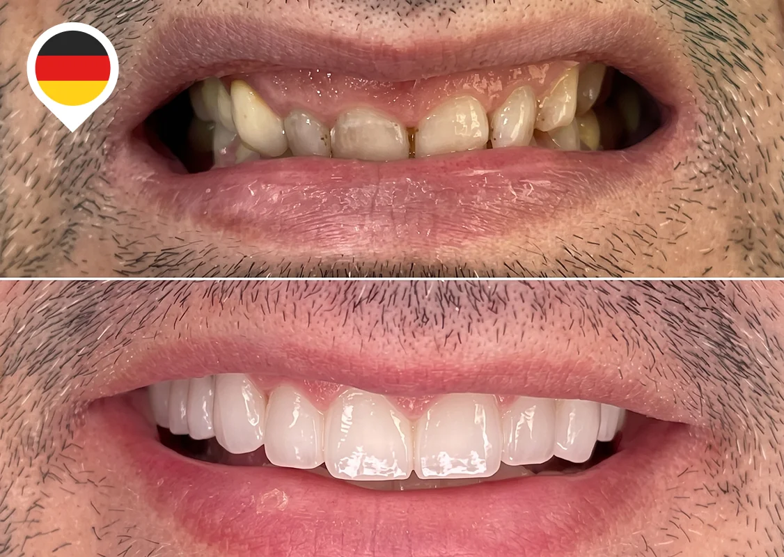 Misaligned, worn upper teeth evened out