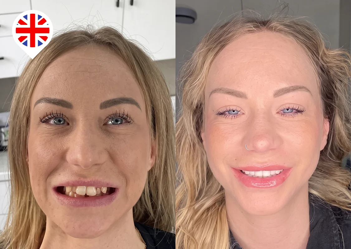Small, gapped front teeth corrected