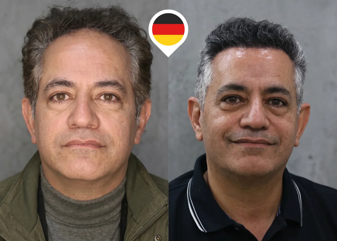 Receding hairline and deep temples restoration