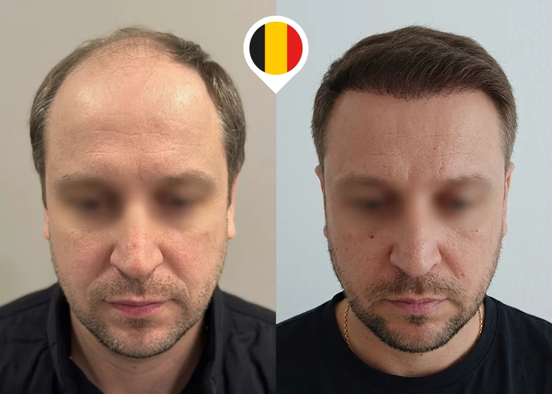 Receding hairline and frontal thinning restoration