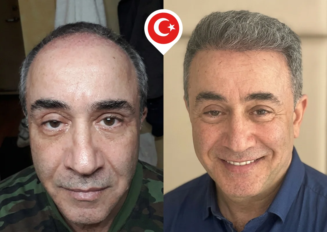 Receding hairline and frontal density restoration