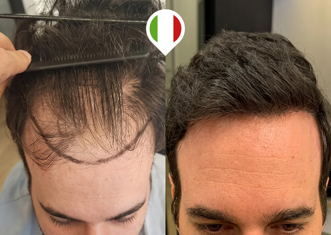 Hairline redesign and temples restoration