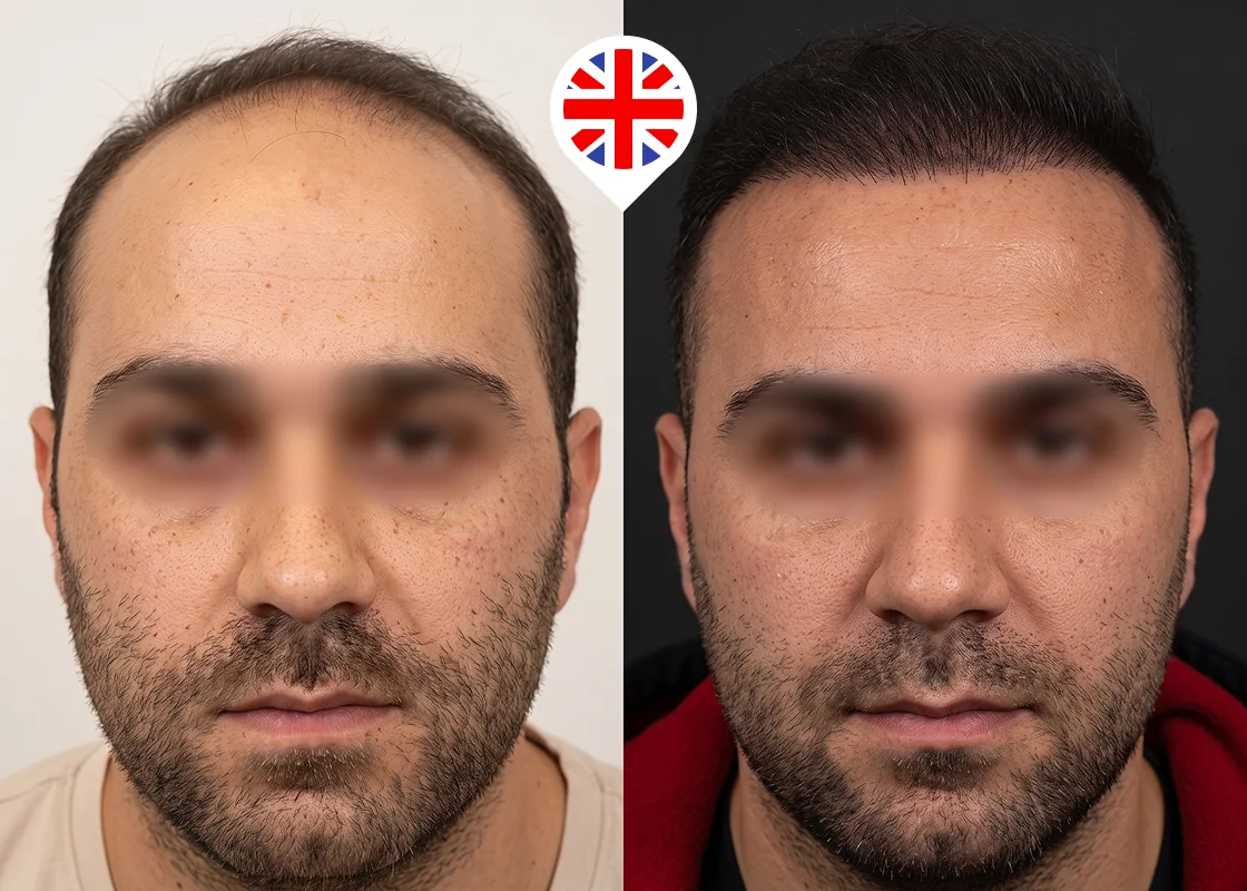 Hairline lowering and temples restoration