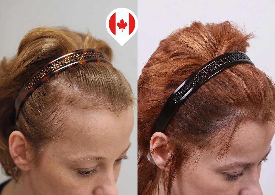 Frontal hairline and temple thinning restoration