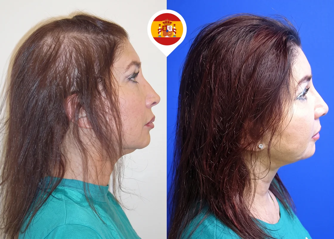Top-of-scalp thinning restoration