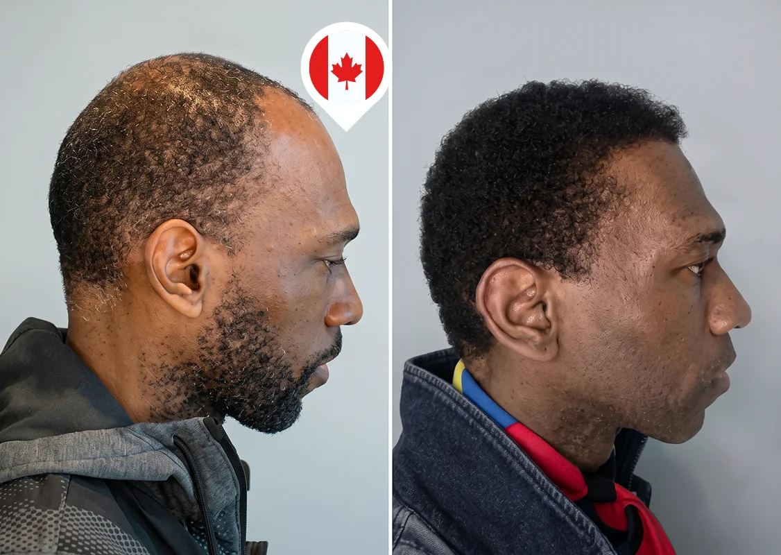 Frontal zone and top restoration in Afro-textured hair